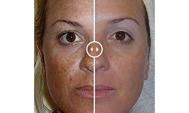 DermaTransformation: facial resurfacing and non-surgical lifting