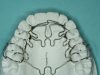 Single Visit Dentistry